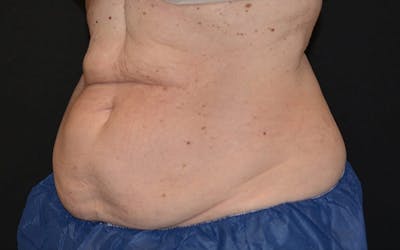 CoolSculpting Before & After Gallery - Patient 317645 - Image 2