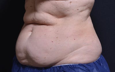 CoolSculpting Before & After Gallery - Patient 317645 - Image 1