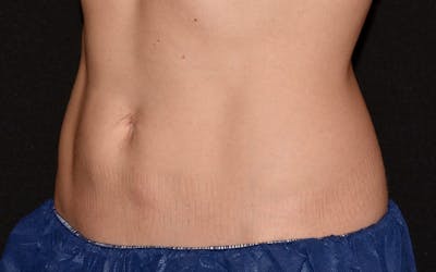 CoolSculpting Before & After Gallery - Patient 407461 - Image 2