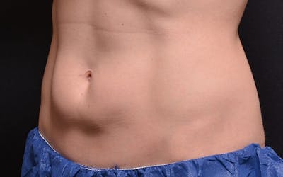 CoolSculpting Before & After Gallery - Patient 407461 - Image 1