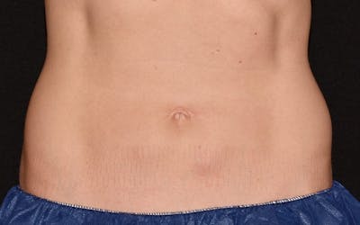 CoolSculpting Before & After Gallery - Patient 165643 - Image 2