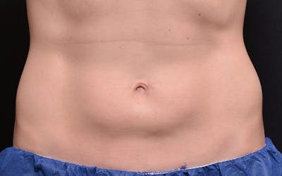 CoolSculpting Before & After Gallery - Patient 165643 - Image 1