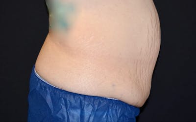 CoolSculpting Before & After Gallery - Patient 415637 - Image 2