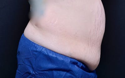 CoolSculpting Before & After Gallery - Patient 415637 - Image 1