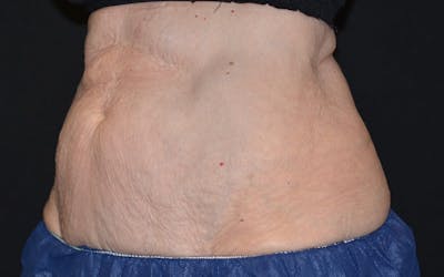 CoolSculpting Before & After Gallery - Patient 356464 - Image 2