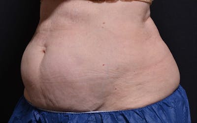 CoolSculpting Before & After Gallery - Patient 356464 - Image 1