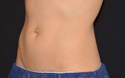 CoolSculpting Before & After Gallery - Patient 360057 - Image 2