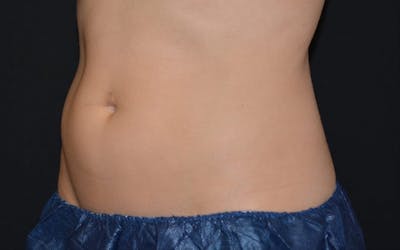 CoolSculpting Before & After Gallery - Patient 360057 - Image 1