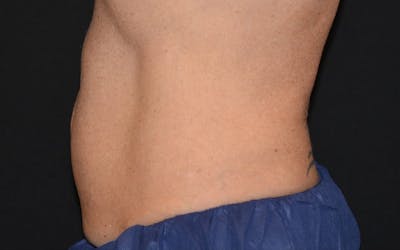 CoolSculpting Before & After Gallery - Patient 125709 - Image 2