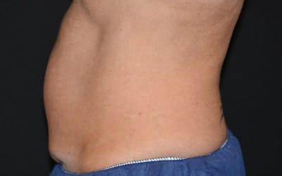 CoolSculpting Before & After Gallery - Patient 125709 - Image 1
