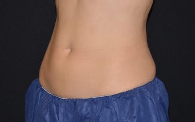 CoolSculpting Before & After Gallery - Patient 353160 - Image 2