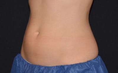 CoolSculpting Before & After Gallery - Patient 353160 - Image 1