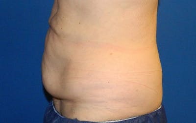CoolSculpting Before & After Gallery - Patient 858788 - Image 1