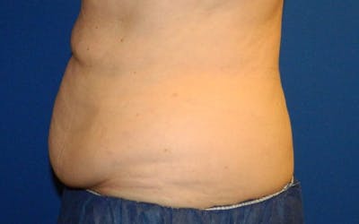 CoolSculpting Before & After Gallery - Patient 858788 - Image 2