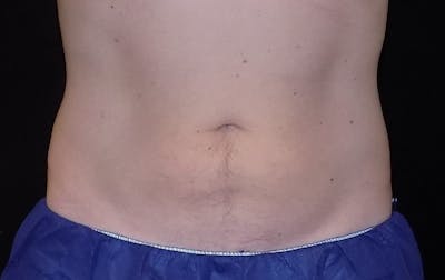 CoolSculpting Before & After Gallery - Patient 326423 - Image 2