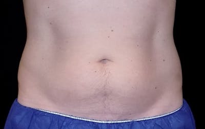 CoolSculpting Before & After Gallery - Patient 326423 - Image 1