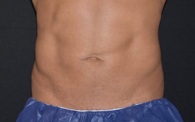 CoolSculpting Before & After Gallery - Patient 261059 - Image 2