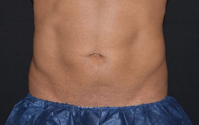CoolSculpting Before & After Gallery - Patient 261059 - Image 1