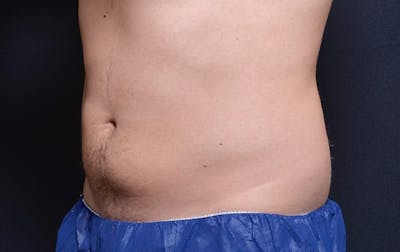 CoolSculpting Before & After Gallery - Patient 152752 - Image 2
