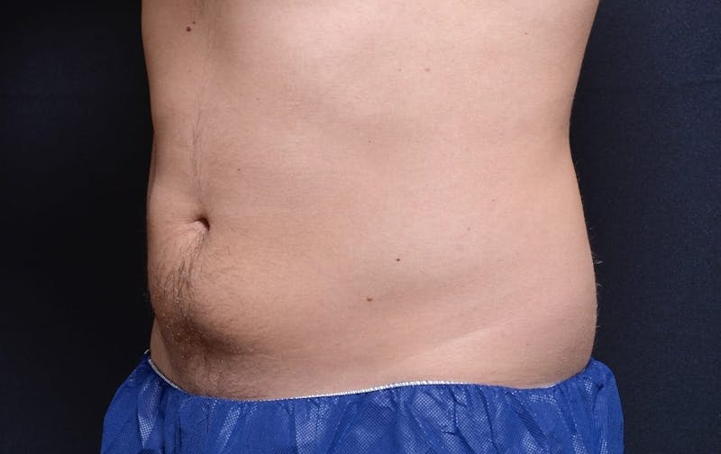 CoolSculpting Before & After Gallery - Patient 152752 - Image 2