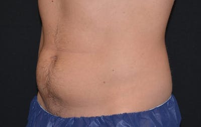 CoolSculpting Before & After Gallery - Patient 152752 - Image 1