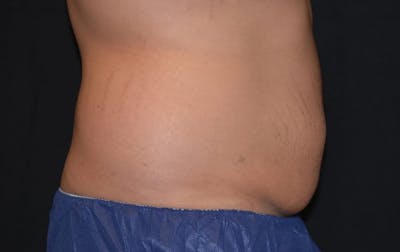 CoolSculpting Before & After Gallery - Patient 331131 - Image 2