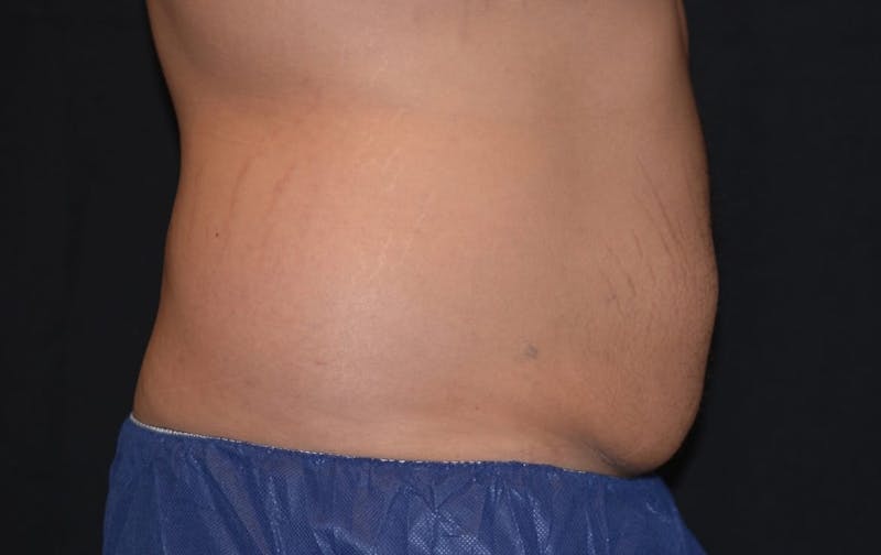 CoolSculpting Before & After Gallery - Patient 331131 - Image 2