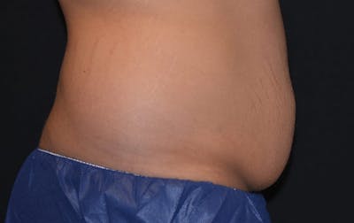 CoolSculpting Before & After Gallery - Patient 331131 - Image 1