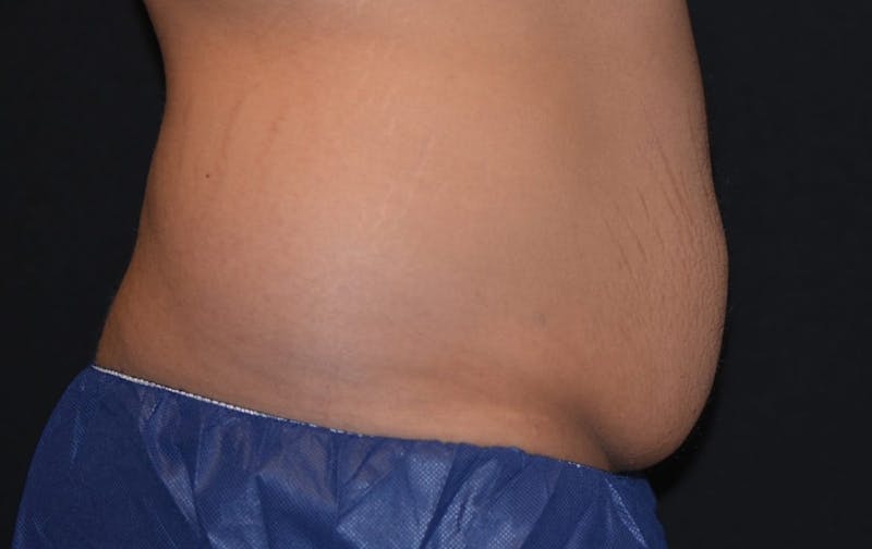 CoolSculpting Before & After Gallery - Patient 331131 - Image 1