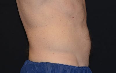 CoolSculpting Before & After Gallery - Patient 253235 - Image 2