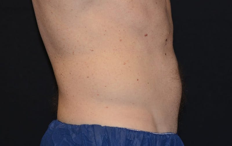 CoolSculpting Before & After Gallery - Patient 253235 - Image 2