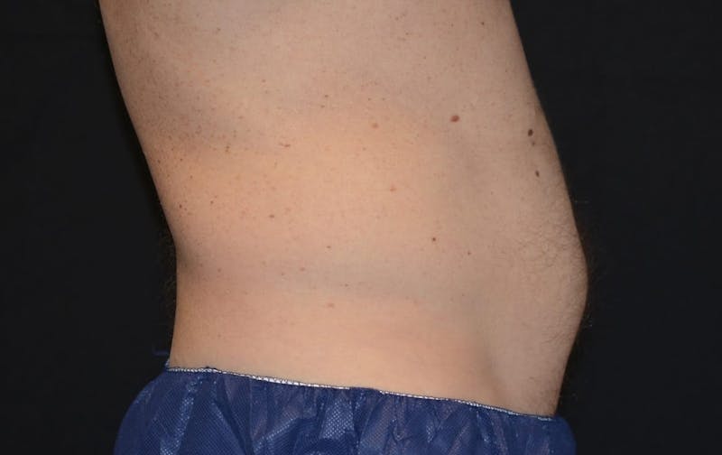 CoolSculpting Before & After Gallery - Patient 253235 - Image 1