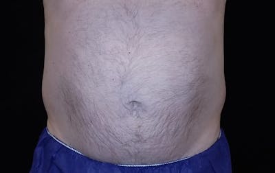 CoolSculpting Before & After Gallery - Patient 205968 - Image 2