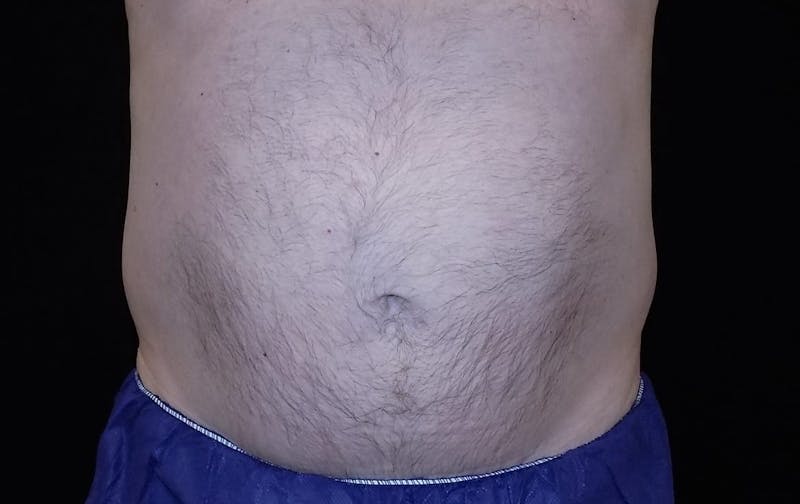 CoolSculpting Before & After Gallery - Patient 205968 - Image 2
