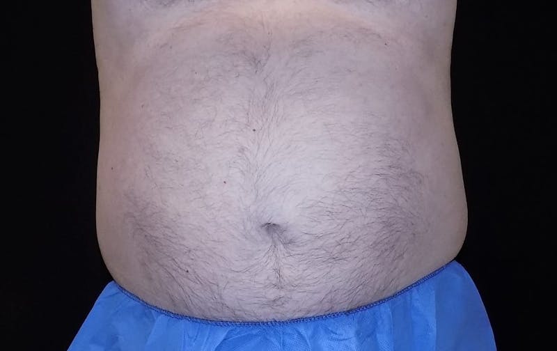 CoolSculpting Before & After Gallery - Patient 205968 - Image 1
