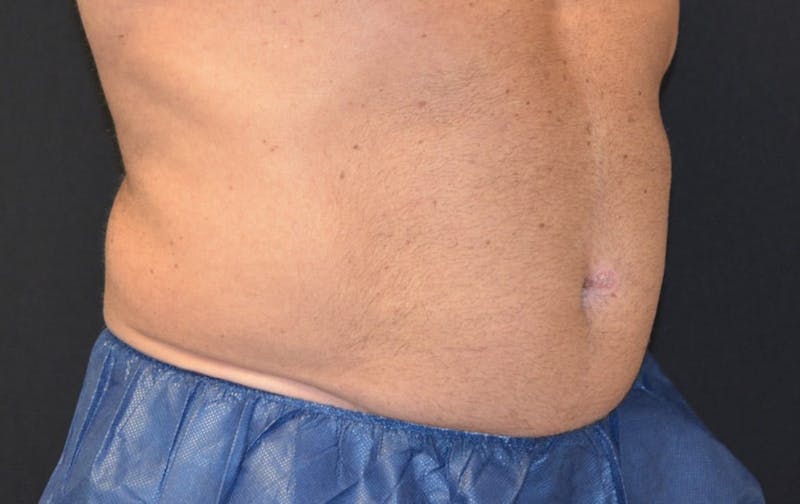 CoolSculpting Before & After Gallery - Patient 380728 - Image 2