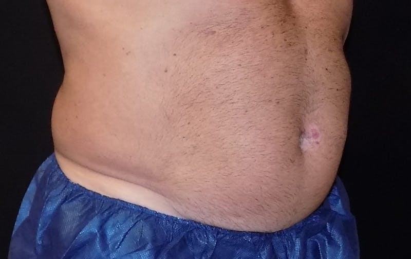 CoolSculpting Before & After Gallery - Patient 380728 - Image 1