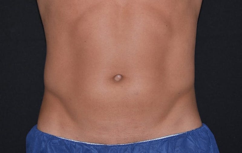 CoolSculpting Before & After Gallery - Patient 348883 - Image 1
