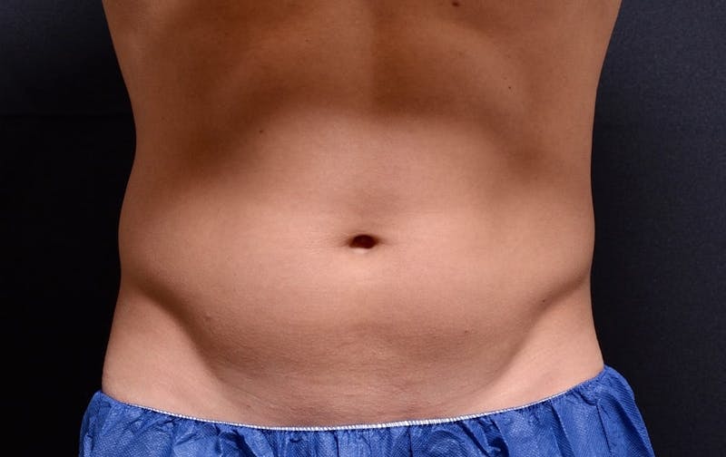 CoolSculpting Before & After Gallery - Patient 348883 - Image 2