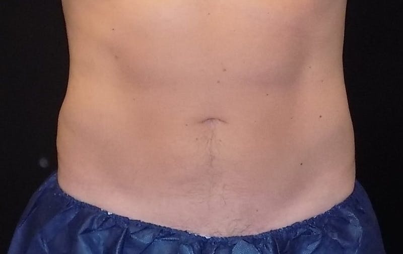 CoolSculpting Before & After Gallery - Patient 220546 - Image 2