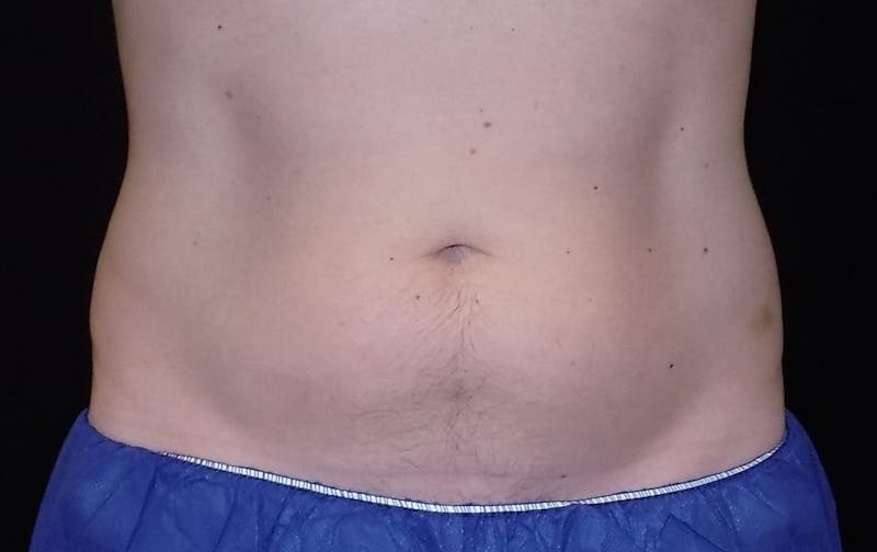 CoolSculpting Before & After Gallery - Patient 220546 - Image 1