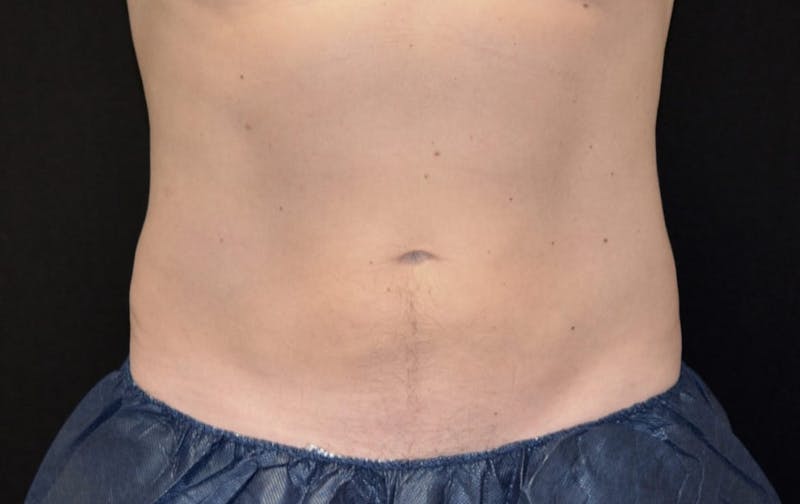 CoolSculpting Before & After Gallery - Patient 375305 - Image 2