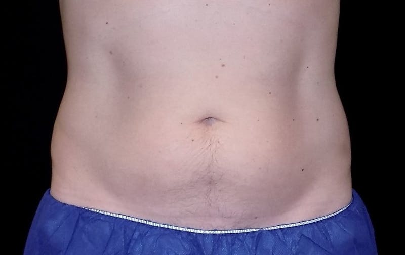 CoolSculpting Before & After Gallery - Patient 375305 - Image 1