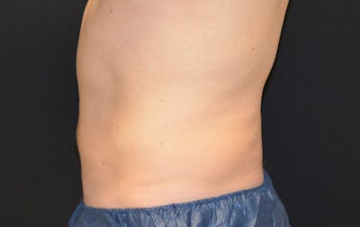 CoolSculpting Before & After Gallery - Patient 408329 - Image 2
