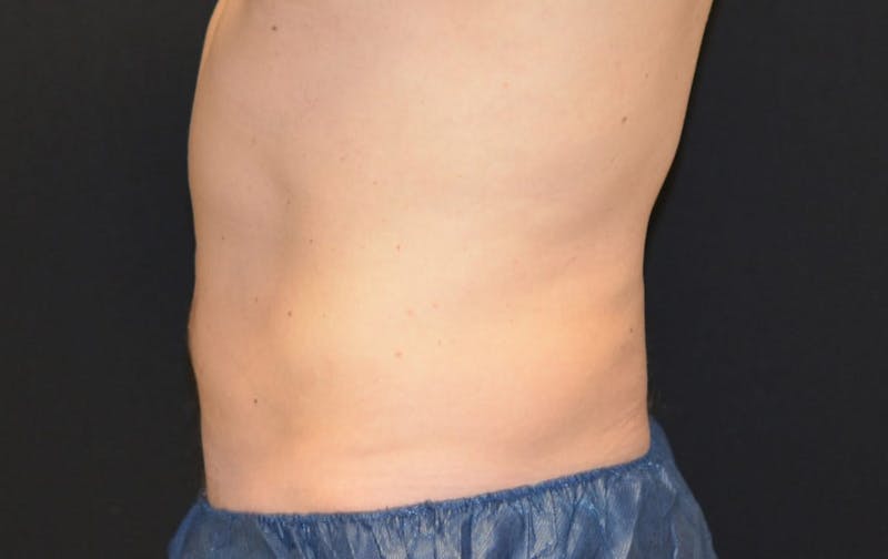CoolSculpting Before & After Gallery - Patient 408329 - Image 2