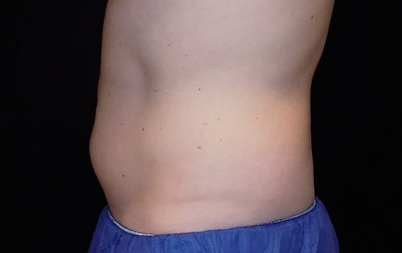 CoolSculpting Before & After Gallery - Patient 408329 - Image 1
