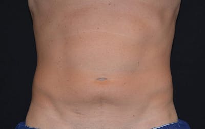 CoolSculpting Before & After Gallery - Patient 345782 - Image 2