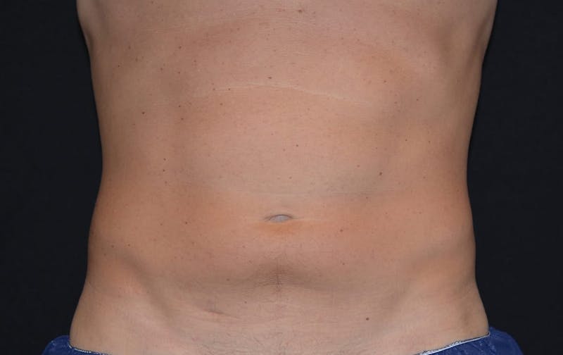 CoolSculpting Before & After Gallery - Patient 345782 - Image 2