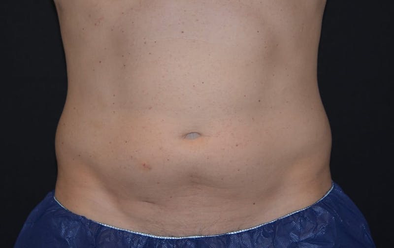 CoolSculpting Before & After Gallery - Patient 345782 - Image 1