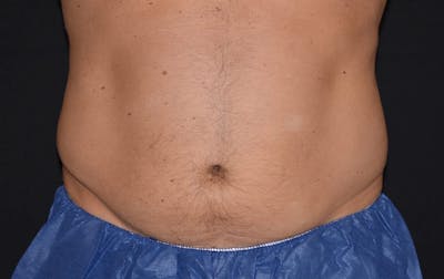 CoolSculpting Before & After Gallery - Patient 328997 - Image 2